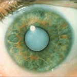 Катаракта — помутнение хрусталика глаза